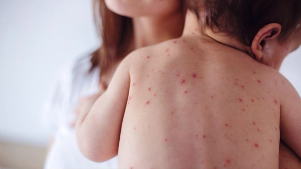 Παγκόσμιος συναγερμός για την ιλαρά