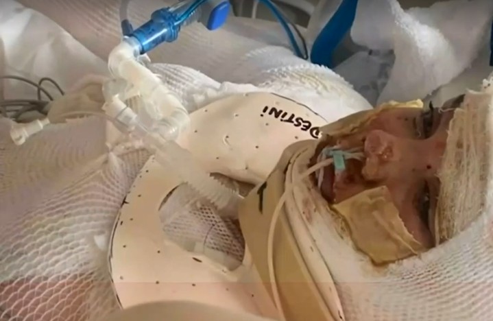 Tik Tok: Με εγκαύματα 13χρονη από την νέα επικίνδυνη πρόκληση του "αναμμένου καθρέφτη"