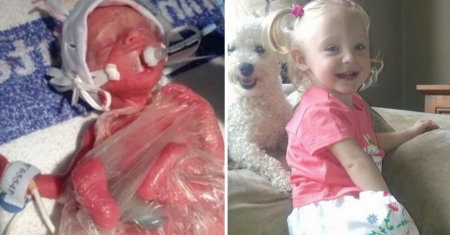 Πρόωρο μωρό που γεννήθηκε μόλις 600 γρ., σήμερα είναι 5 ετών και θα πάει πρώτη φορά σχολείο