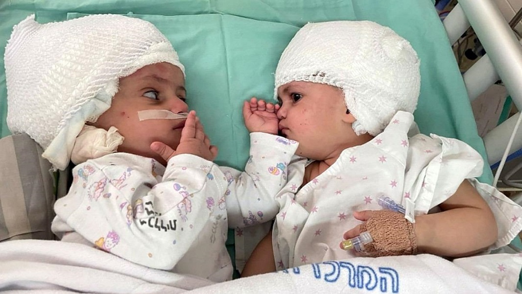 Σιαμαία κοριτσάκια κοιτάχτηκαν για πρώτη φορά μετά από επέμβαση