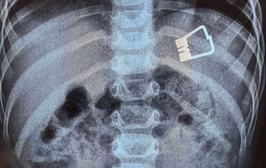 Πώς σώθηκε το παιδί που κατάπιε το μανταλάκι