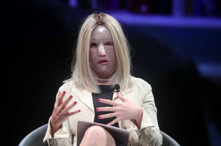 H Ιωάννα γυμνάζεται για πρώτη φορά μετά την επίθεση με βιτριόλι