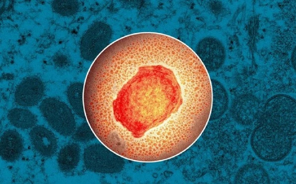 Ευλογιά των πιθήκων: 12 περιστατικά στην Ελλάδα- Με ποια σειρά εμφανίζονται τα συμπτώματα