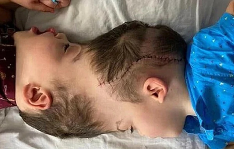 Διαχωρίστηκαν σιαμαία δίδυμα ενωμένα στο κεφάλι- Τα μεγαλύτερα σε ηλικία