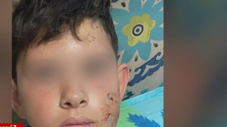 Λαγονήσι: Σκύλος επιτέθηκε άγρια σε 13χρονο που πήγαινε στο σχολείο - Έχει βαθιά τραύματα