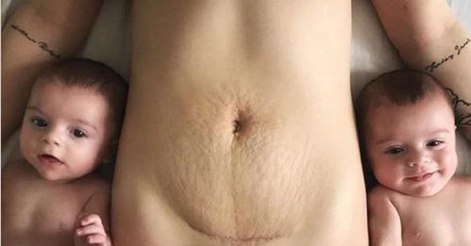 Ηχηρό μήνυμα στέλνει μια μαμά διδύμων δείχνοντας τη φωτογραφία με τις ουλές της καισαρικής!