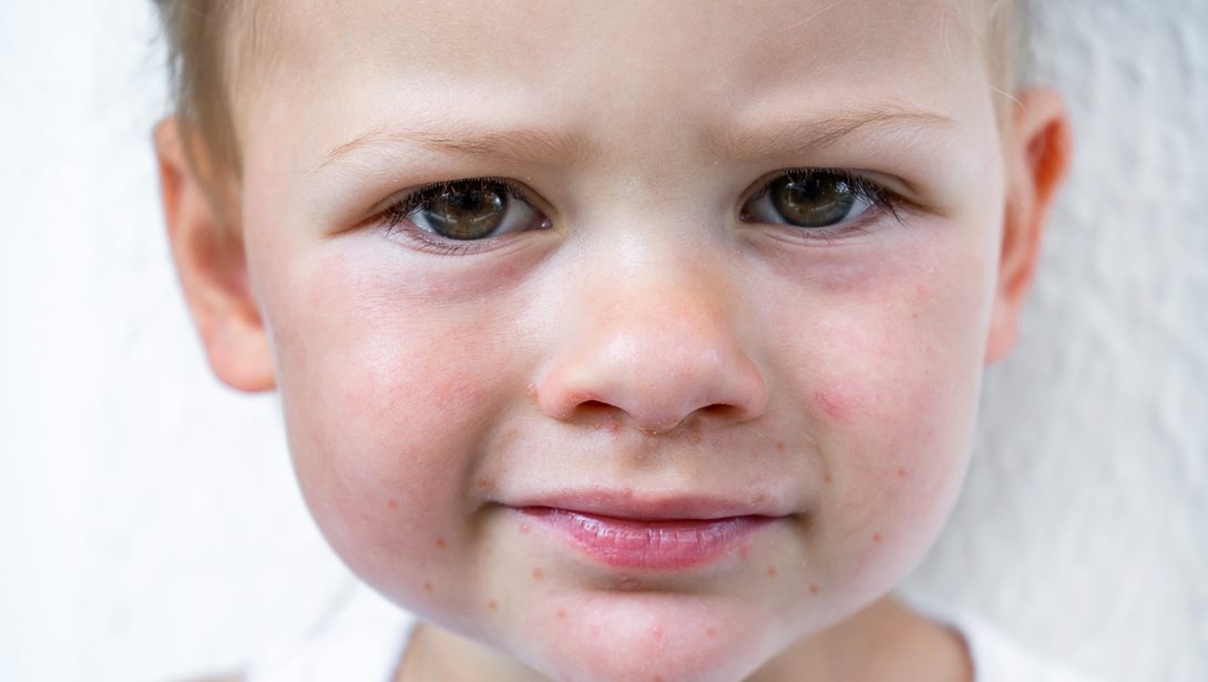 Κοξάκι το καλοκαίρι: Τι πρέπει να ξέρουν οι γονείς