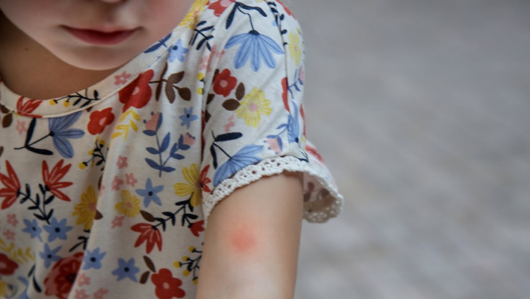 Κάτι τσίμπησε το παιδί: Τι κάνουμε τώρα;