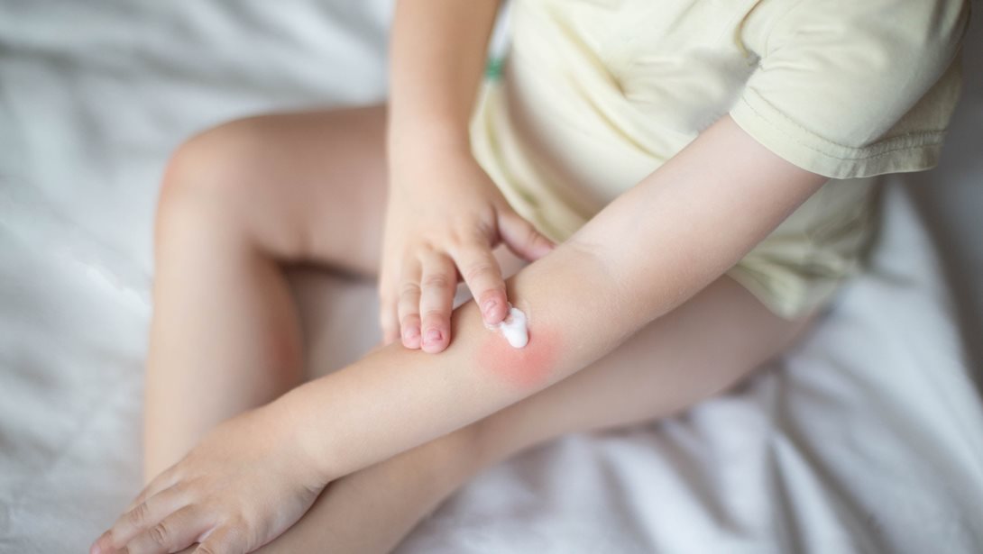 Έγκαυμα στα παιδιά: Τι δεν πρέπει ποτέ να κάνουμε