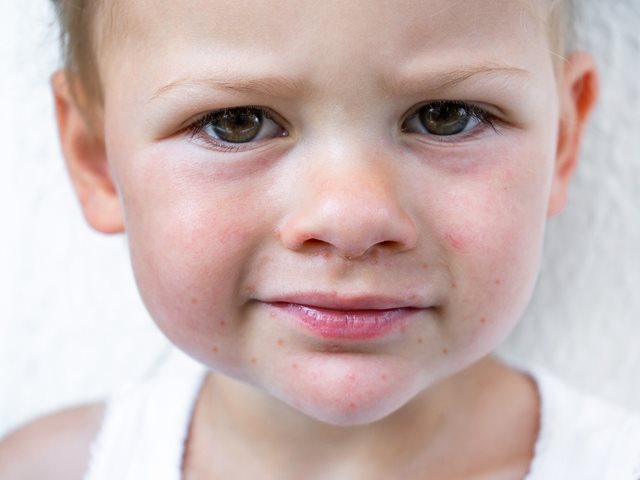 Κοξάκι το καλοκαίρι: Τι πρέπει να ξέρουν οι γονείς