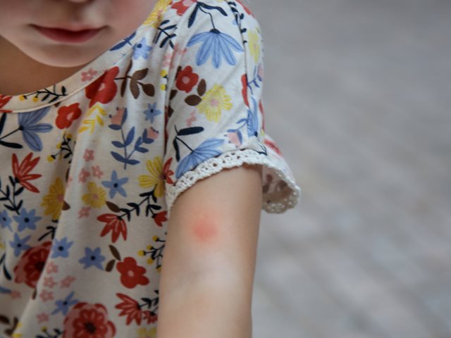 Κάτι τσίμπησε το παιδί: Τι κάνουμε τώρα;