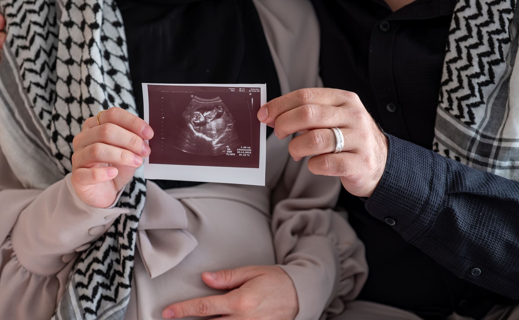 Ο υποσιτισμός εγκύων και βρεφών στη Γάζα θα αφήσει πληγές που θα διαρκέσουν "για γενιές"